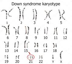 Sindrome de down